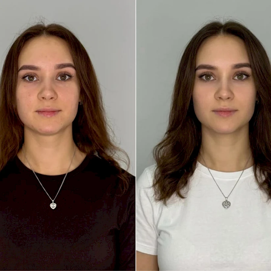 Биорегенерация лица сферогель