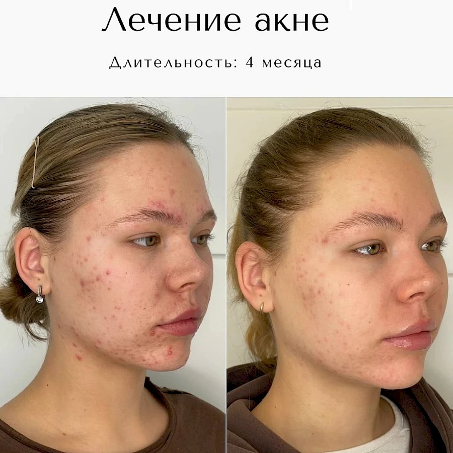 Лечение акне