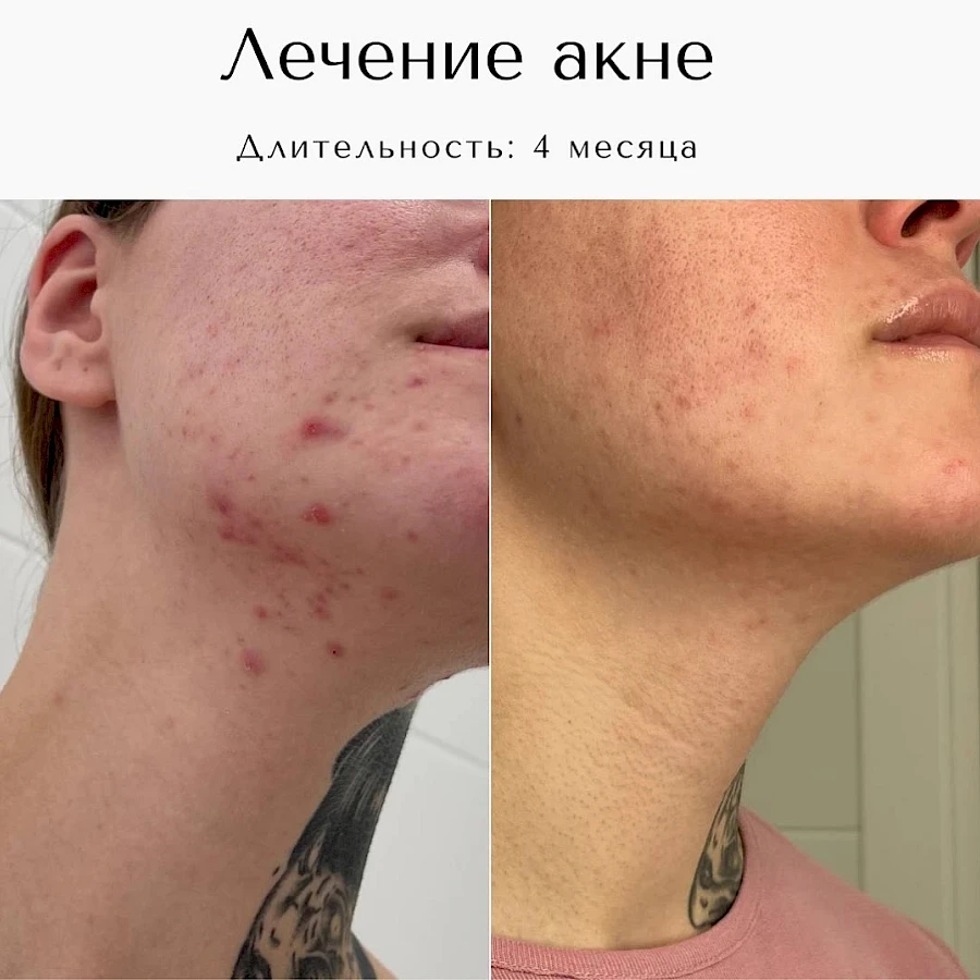 Лечение акне
