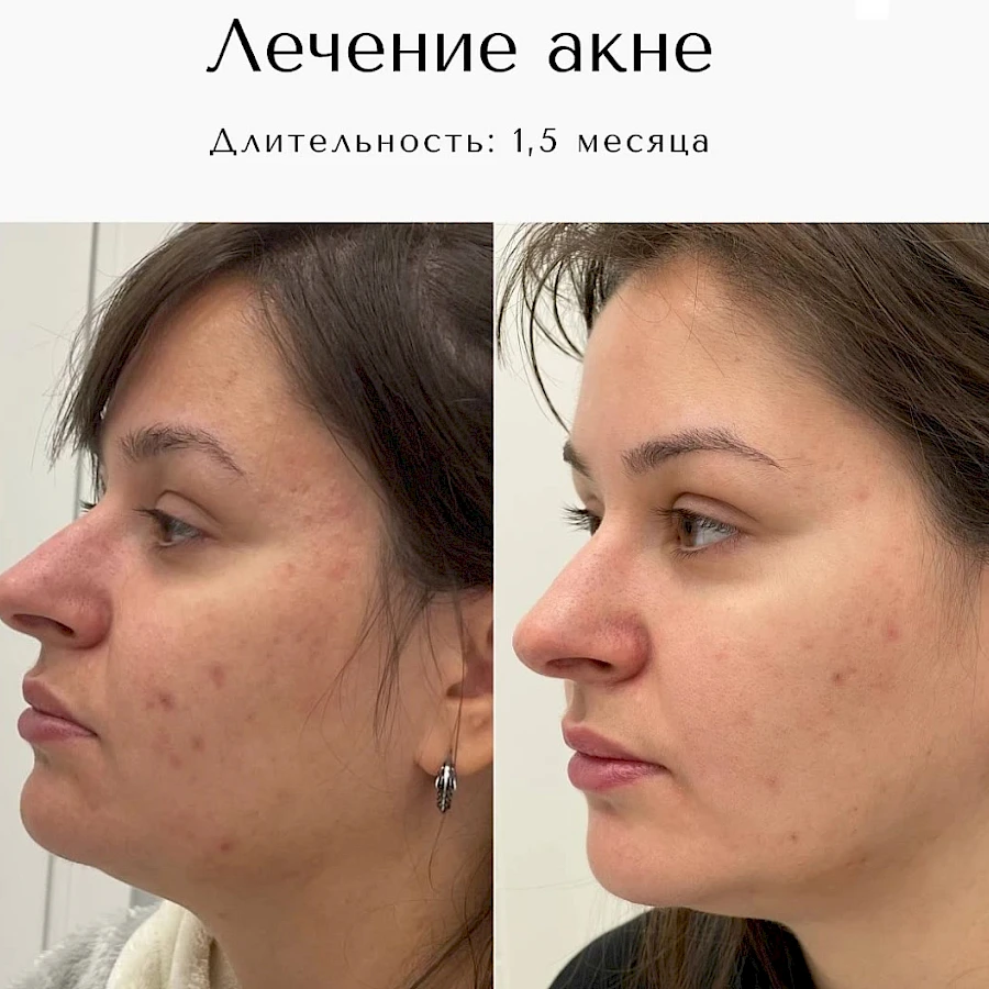 Лечение акне