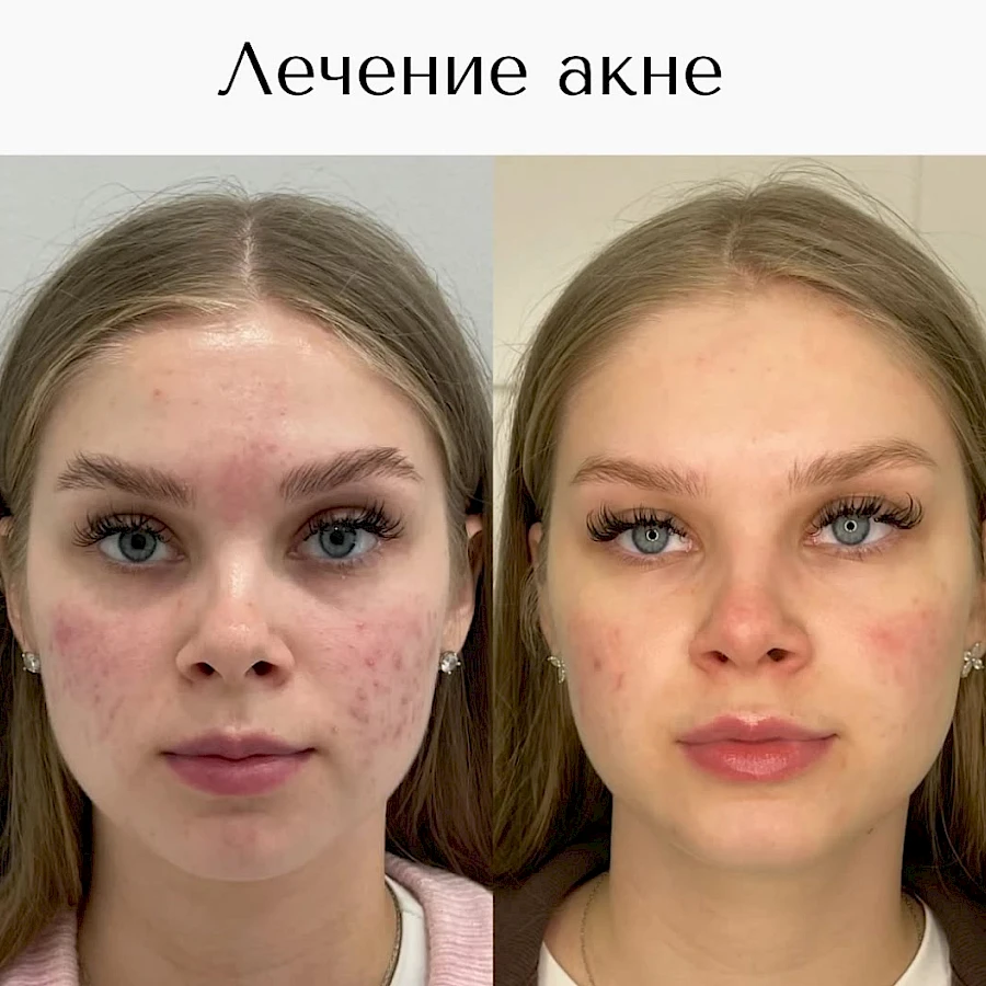 Лечение акне