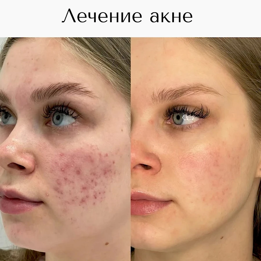 Лечение акне