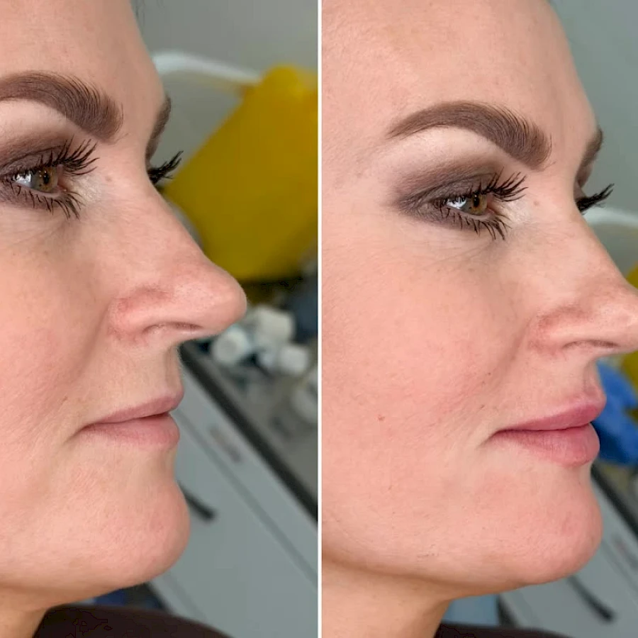 Контурная пластика губ Belotero Lips Shape