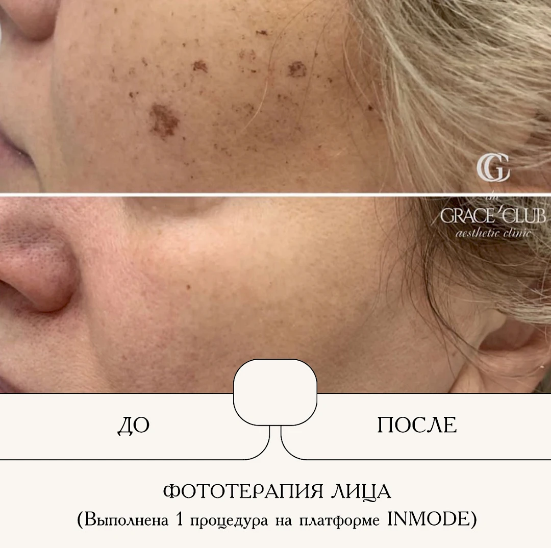 Результат процедуры, кадр 2