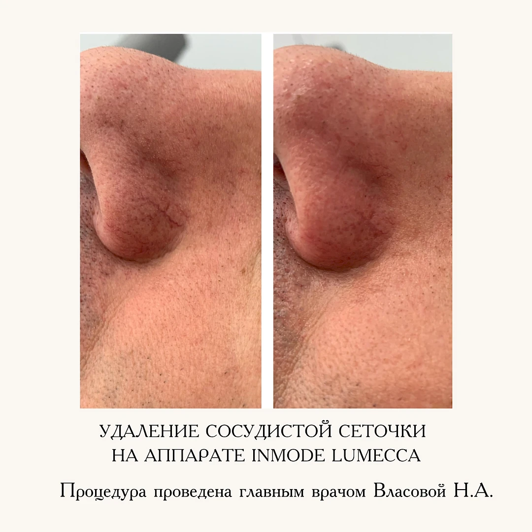 Результат процедуры, кадр 4